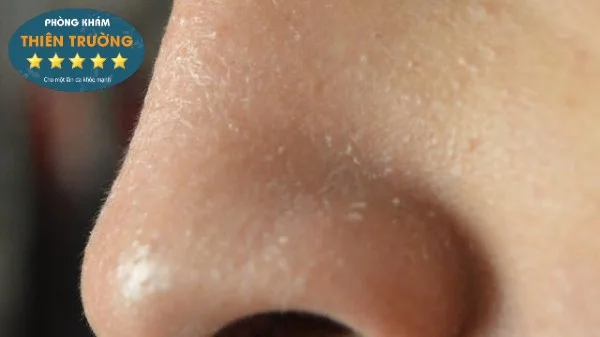 Hình ảnh: Da khô 2 ben cánh mũi