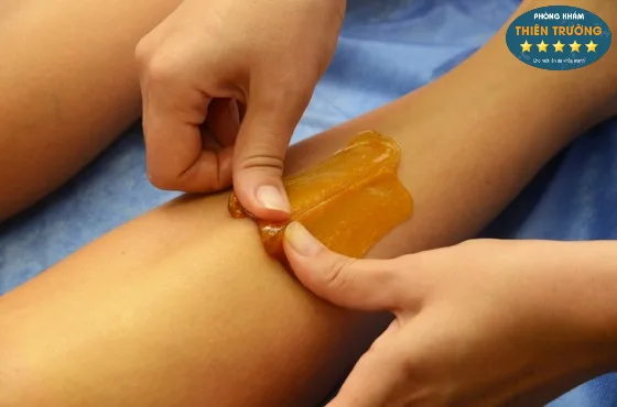 Hình ảnh: Triệt lông bằng phương pháp cũ,