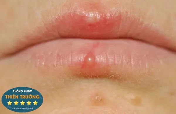 Hình ảnh: Mụn nước.