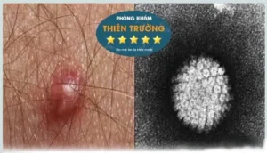 Hình ảnh: Virus mụn cóc sinh dục.