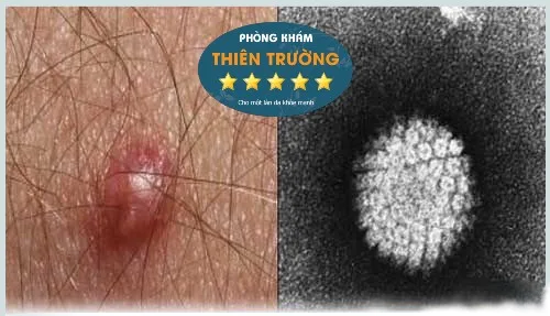 Hình ảnh: Virus mụn cóc sinh dục.