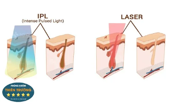 Hình ảnh: Tia laaser công nghệ diode laaser .
