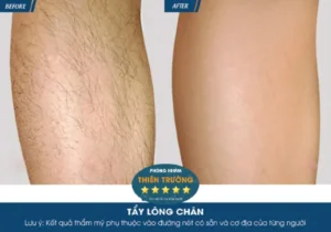 Hình ảnh: trước sau triệt lông chân.