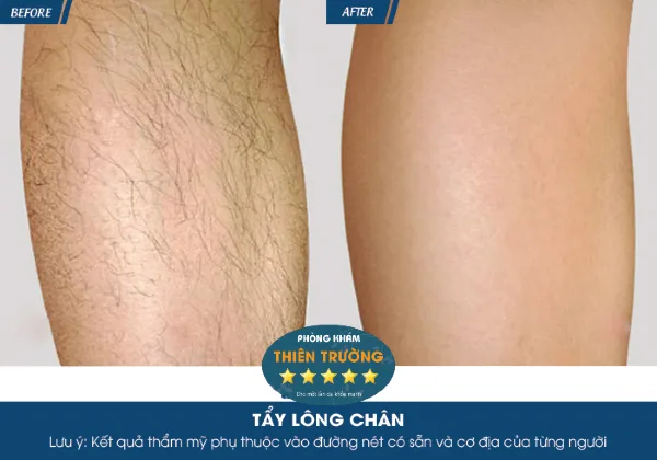 Hình ảnh: trước sau triệt lông chân.