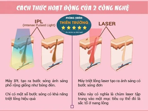 Hình ảnh: Sự khác biệt giữa công nghệ IPL và DIODE laser.