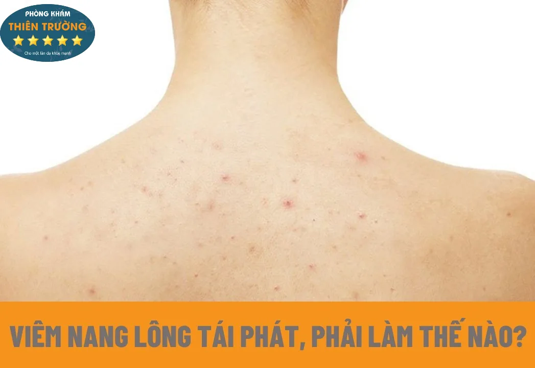 Hình ảnh: Viêm nang lông tái phát, phải làm như thế nào?