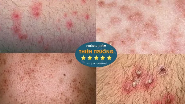 Hình ảnh: Viêm nang lông