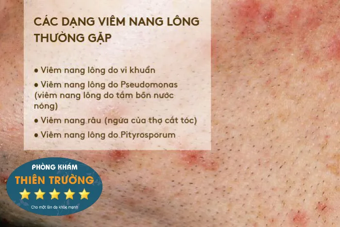 Hình ảnh: Các dạng viêm nang lông thường gặp