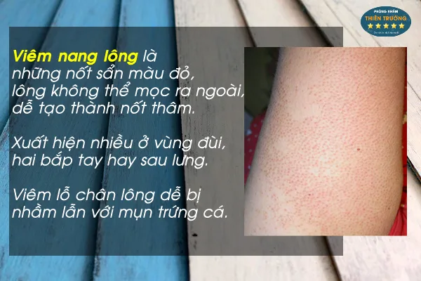 cach-tri-viem-lo-chan-long-tai-nha