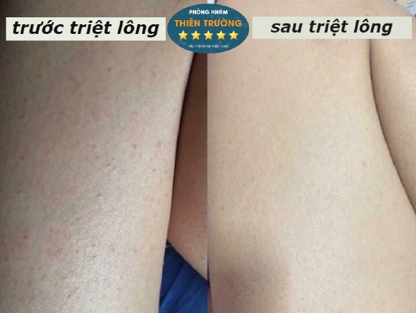 Triệt lông bằng công nghệ laser - Da liễu Thiên Trường