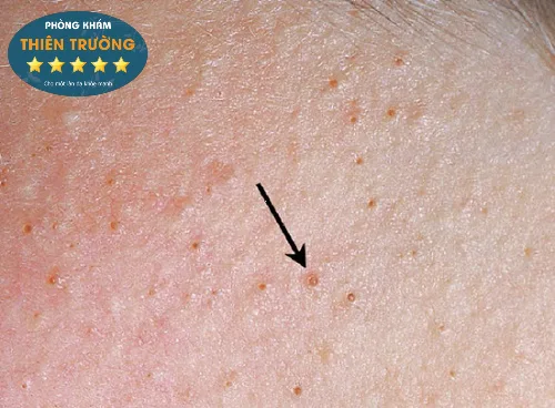 Hình ảnh: Dấu hiệu nhận biết viêm nang lông