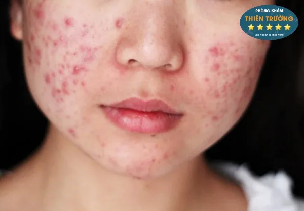 Hình ảnh: Mụn trứng cá.