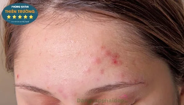 Hình ảnh: Mụn trứng cá.