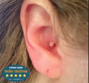 Hình ảnh: Mụn trứng cá ở tai.