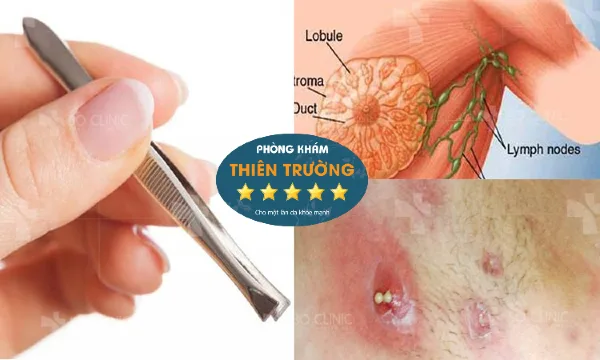 Hình ảnh: Dùng nhíp nhổ lông có thể gây viêm.