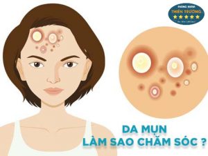 Hình ảnh : Lưu ý khi chăm sóc da mụn