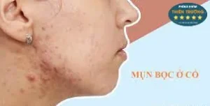 Hình ảnh: Mụn trứng cá ở cổ.