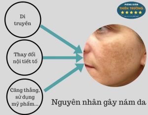 Hình ảnh: NGuyeennhaan gay nám và tàn nhang.