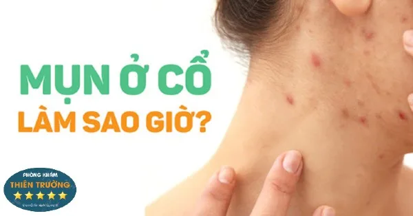 noi-mun-o-co