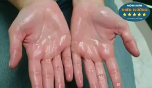 Hình ảnh: Mồ hôi tay.
