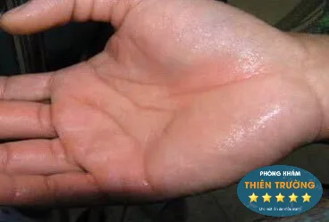 Hình ảnh: Mồ hôi tay.