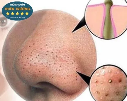 Hình ảnh: Mụn ẩn ở mũi.