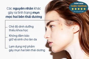 Hình ảnh: Mụn ở thái dương.