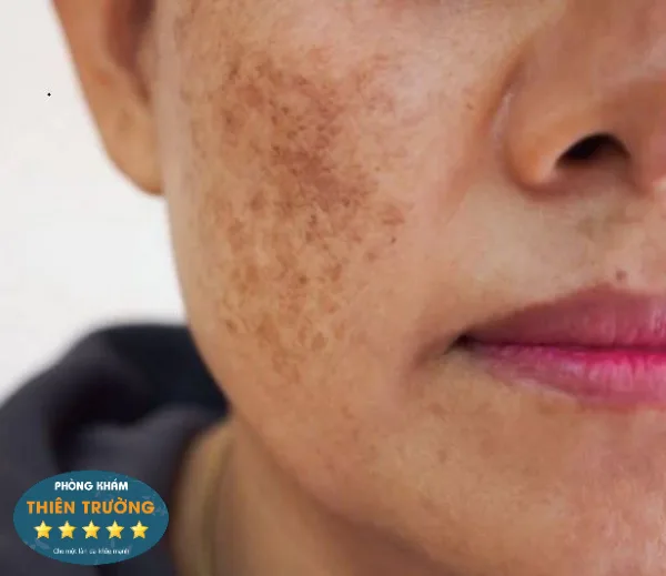 Hình ảnh: Nám da.