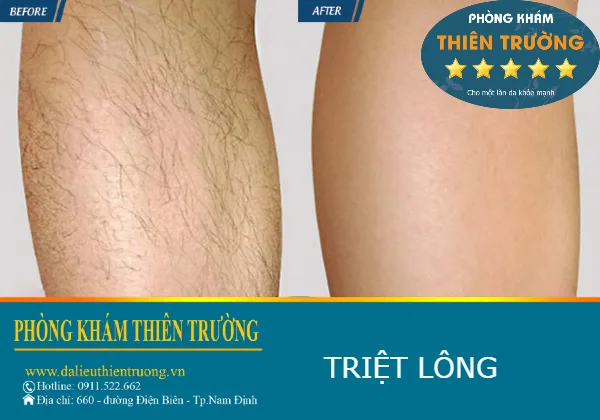 Hình ảnh: Hiệu quả triệt lông công nghệ mới.