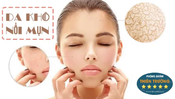 mat-na-tri-mun-cho-da-kho