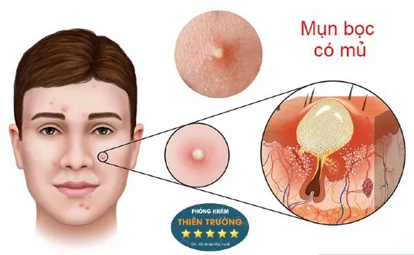mụn bọc có mủ (2)