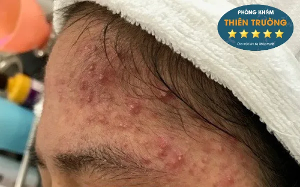 mụn trứng cá thái dương