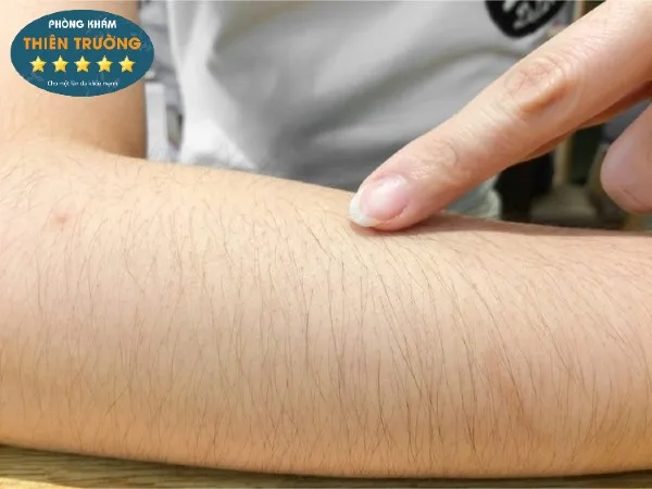 Hình ảnh: Lông tay cứng và rậm