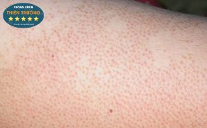 Hình ảnh: Viêm nang lông vùng đùi mông.