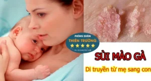 Hình ảnh: Sùi mào gà có thể di truyền từ mẹ sang con.