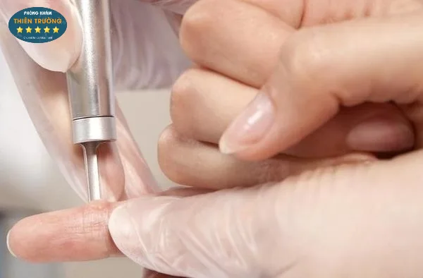 Hình ảnh: Phương pháp Laser CO2 Fractional để hỗ trợ điều trị hạt cơm