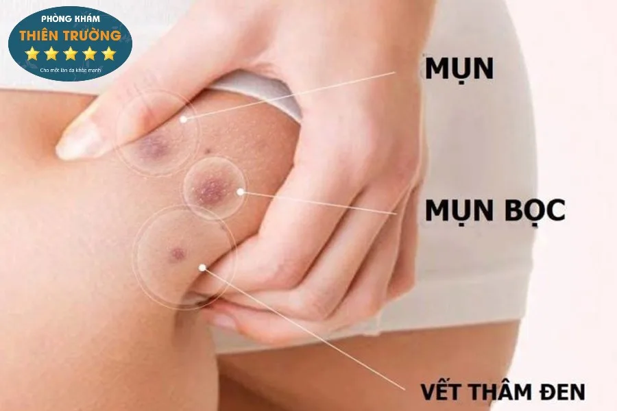 Truy-tim-6-nguy-nhan-khien-mun-hay-moc-o-mong-cua-ban-2