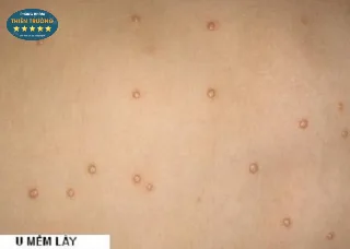 Hình ảnh: U mềm lây.