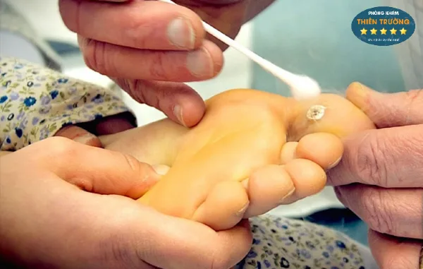 Hình ảnh: Bôi thuốc sau khi hỗ trợ điều trị hạt cơm.