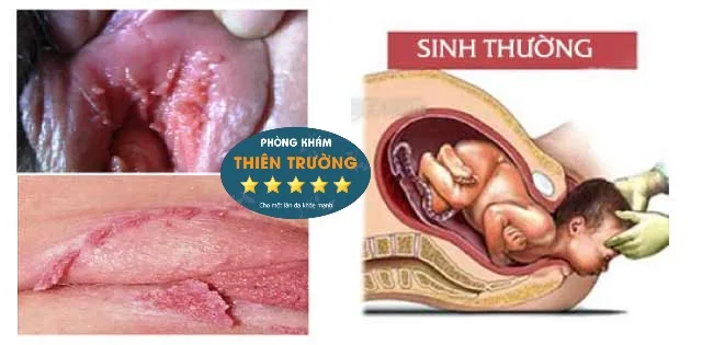 Hình ảnh: Mụn cóc sinh dục khi mang thai.