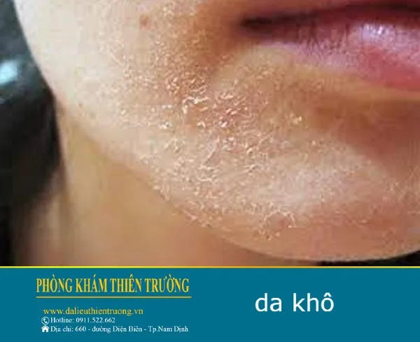 Hình ảnh: Da khô.
