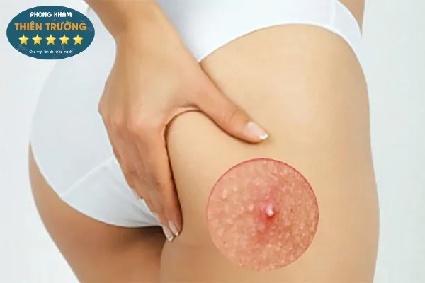Hình ảnh: Mụn bọc ở môn.