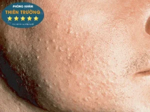 Hình ảnh: Mụn đầu trắng.