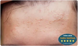 Hình ảnh: Mụn ẩn.