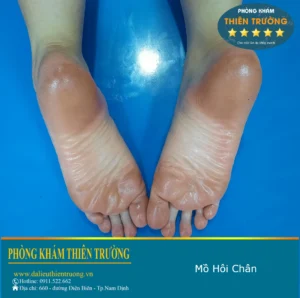 Hình ảnh: Mồ hôi chân ra nhiều.