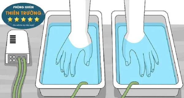 Hình ảnh: Điện di ion điều trị mồ hôi tay.