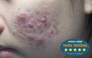 Hình ảnh: Mụn bọc ở má.