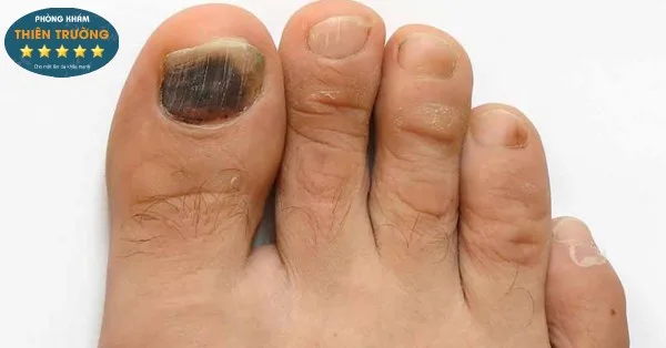 Hình ảnh: Nấm móng gây mồ hôi ở chân.