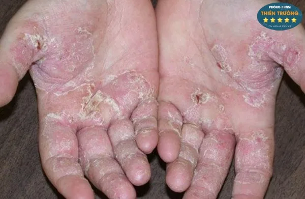 Hình ảnh: Viêm da cơ địa