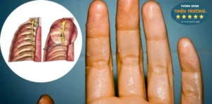 Hình ảnh: Phương pháp cắt hạch giao cảm.